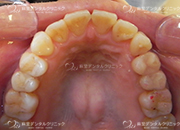 セラミックインレー