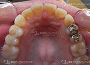 保険のメタルインレー