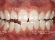 ホワイトニング後の白い歯