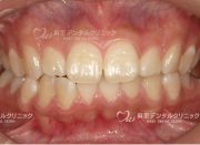 ホワイトニング前で黄ばみが気になります