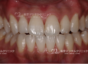 ホワイトニング後さらに白くなりました