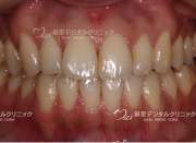 ホワイトニング前から黄ばみは強くないです