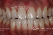ホワイトニング症例2