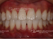 ホワイトニング後ずいぶん白くなりました