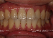 ホワイトニング前は黄色味が強いです