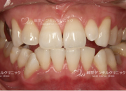 ホワイトニング後少し根元の色が濃いです