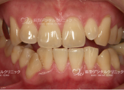 ホワイトニング前の写真です