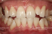 ホワイトニング症例4
