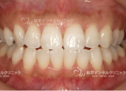 ホワイトニング後の白い歯
