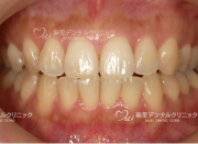 ホワイトニング前で黄ばみが気になります